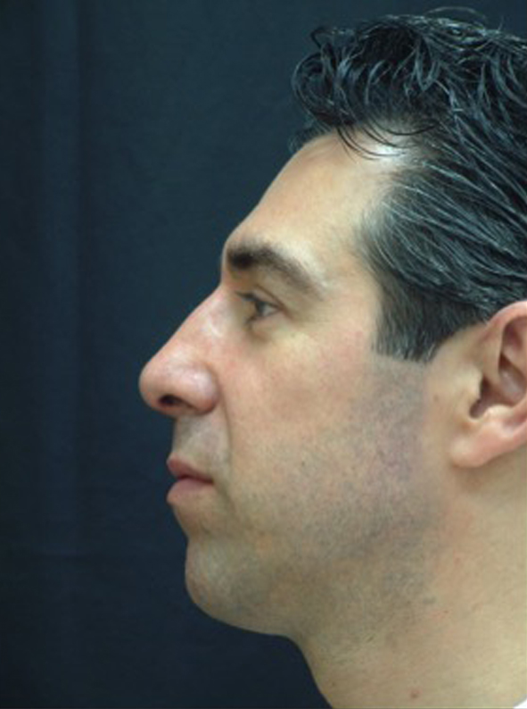 Male patient after nonsurgical rhinoplasty