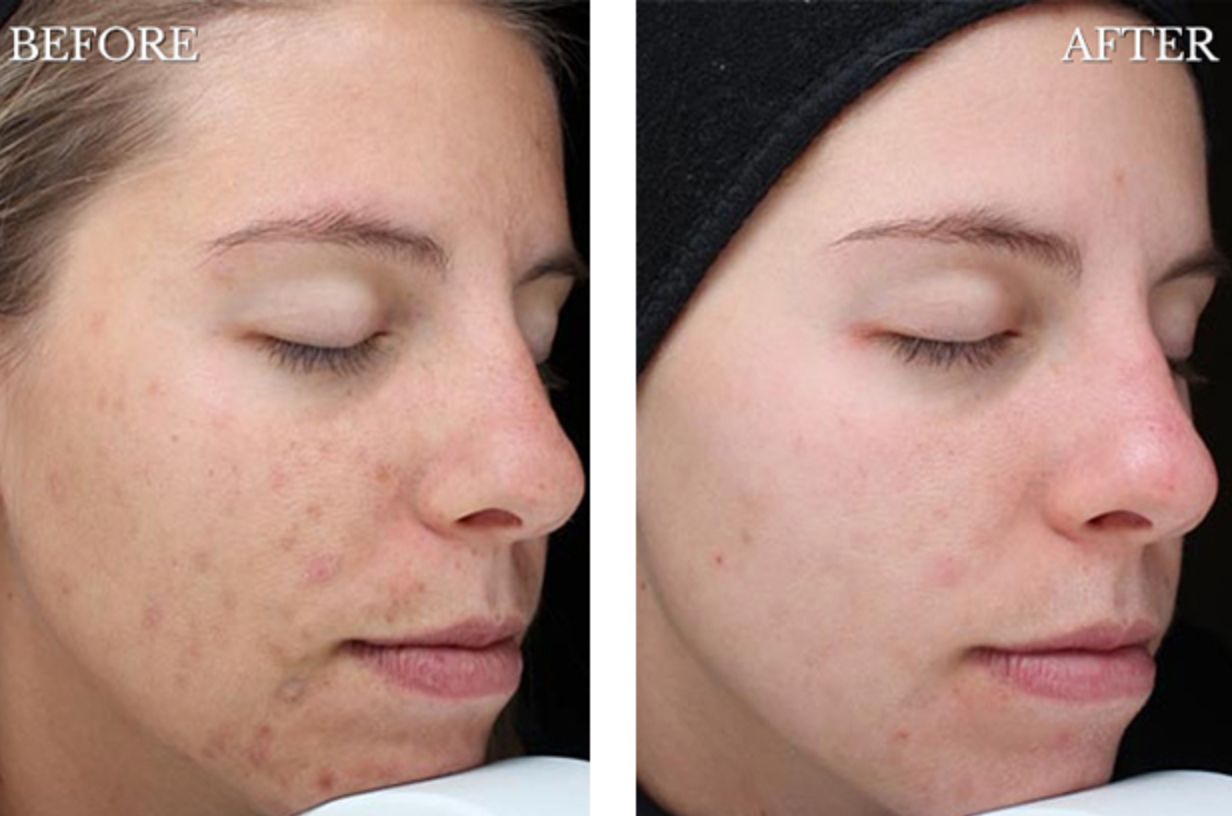 Female patient's face before and after chemical peel treatment