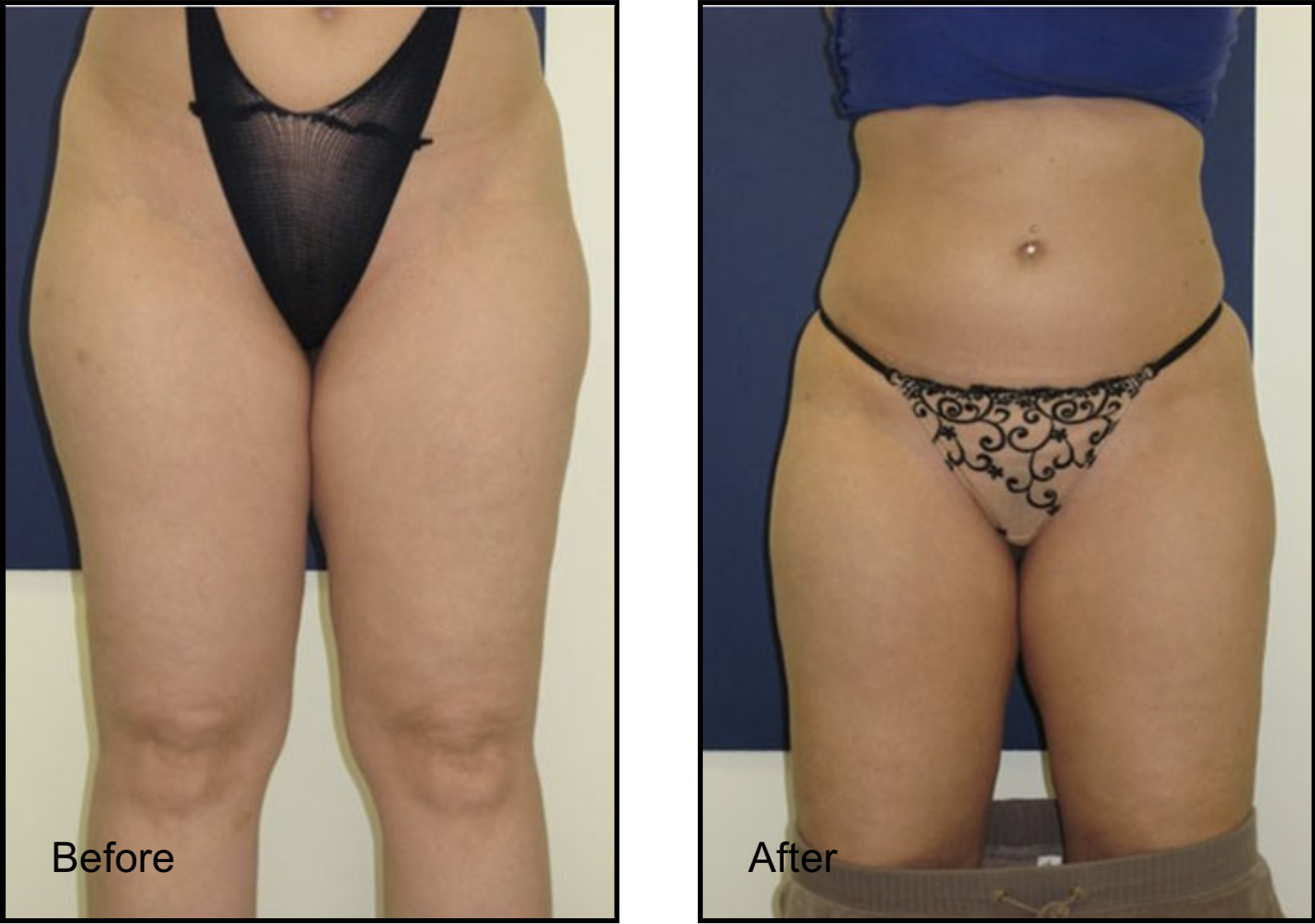 Female patient before and after thighs lipo