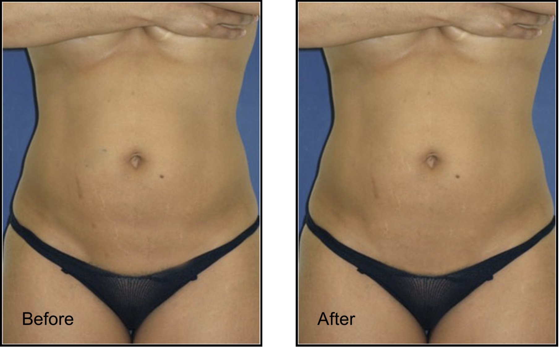 Female patient before and after love handles lipo