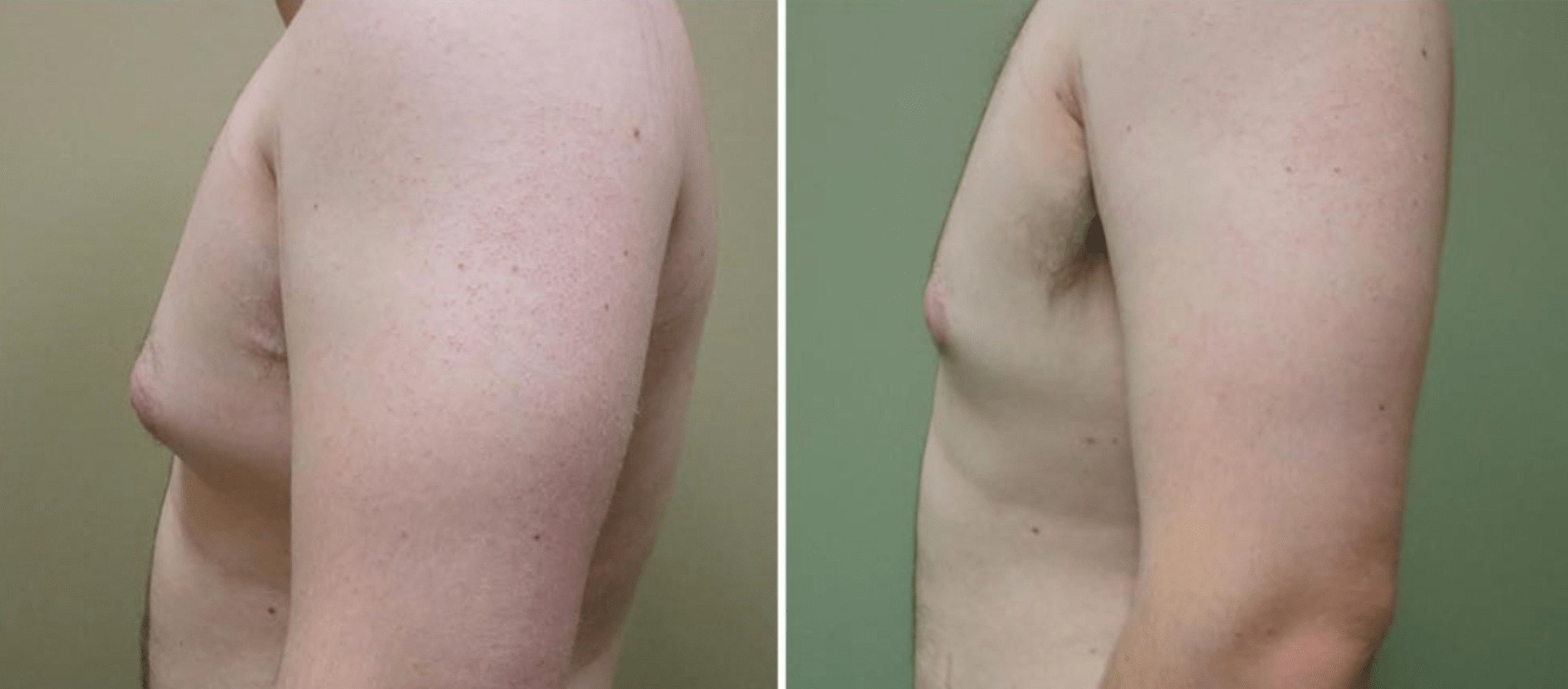 Patient's chest before and after male breast liposuction.
