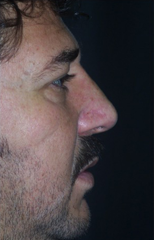 Male patient after Nonsurgical Rhinoplasty