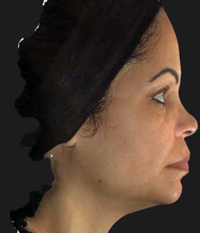 Patient after Neurotox Nefertiti Lower Facelift
