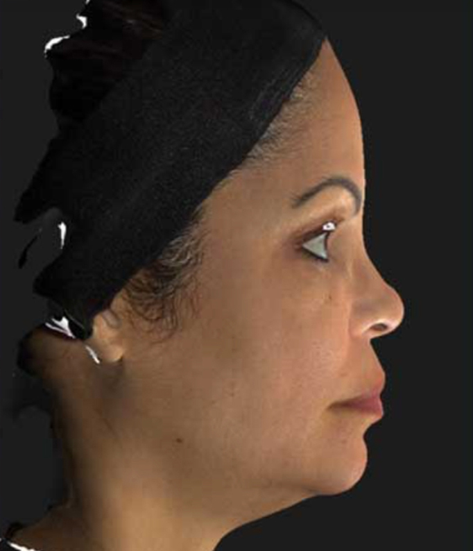 Patient before Neurotox Nefertiti Lower Facelift