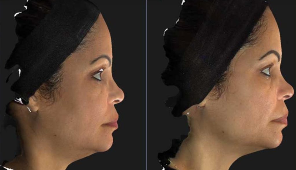 Los Angeles Nefertiti Neck/Lower Face Lift With Neurotox® | Beverly Hills