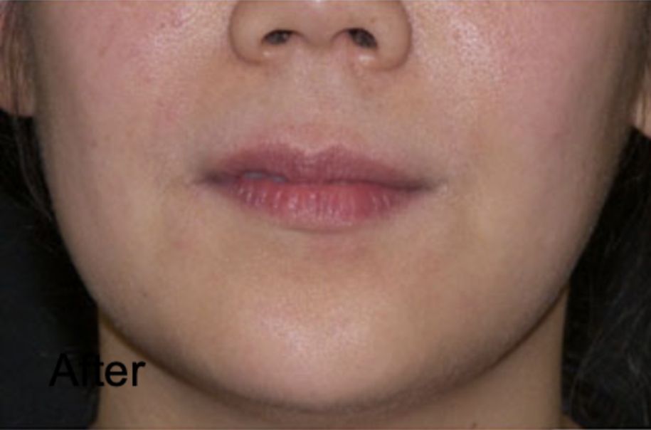 Patient after Neurotox To Contour Your Jawline and Neurotox For Lower Face Slimming
