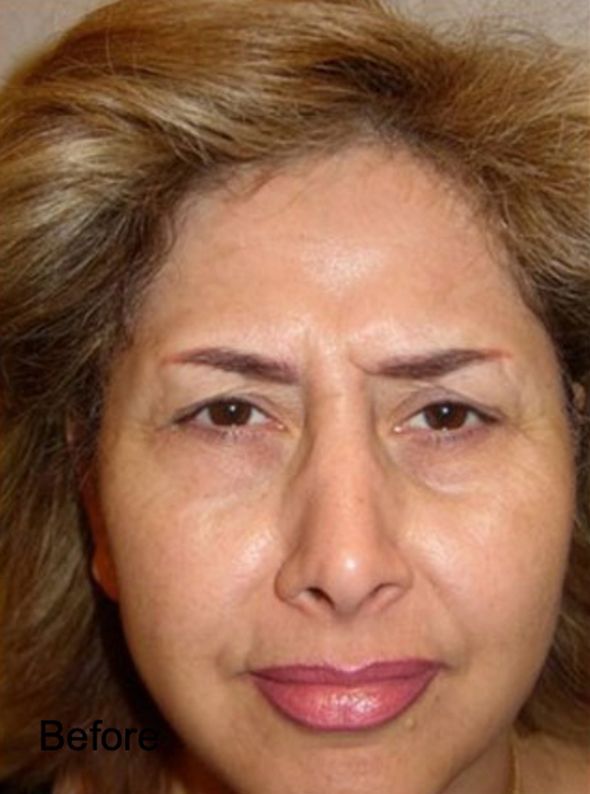 Patient before Non-Surgical Neurotox Browlift