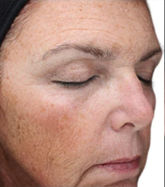 Patient before Chemical Peels