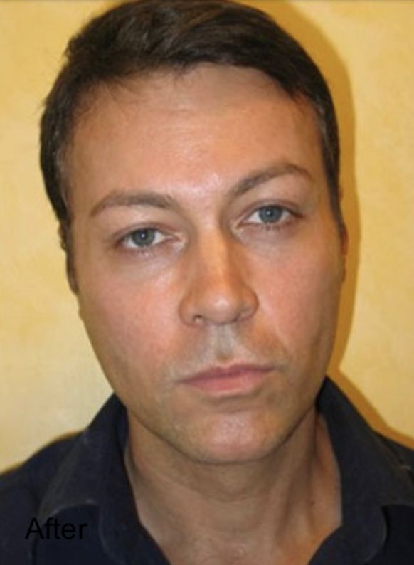 Male patient after Nonsurgical Cheeks Lift and Non-Surgical Fat Face Lift