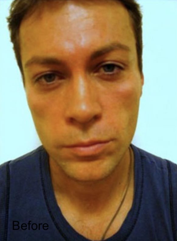 Male patient before Nonsurgical Cheeks Lift and Non-Surgical Fat Face Lift