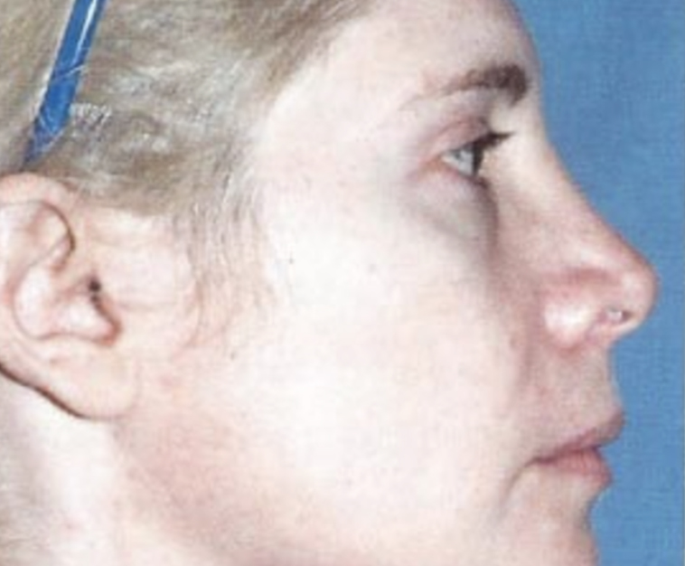 Patient before Non-Surgical Fat Face Lift