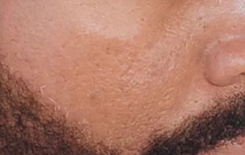 Patient after Neurotox For Large Pores And Acne