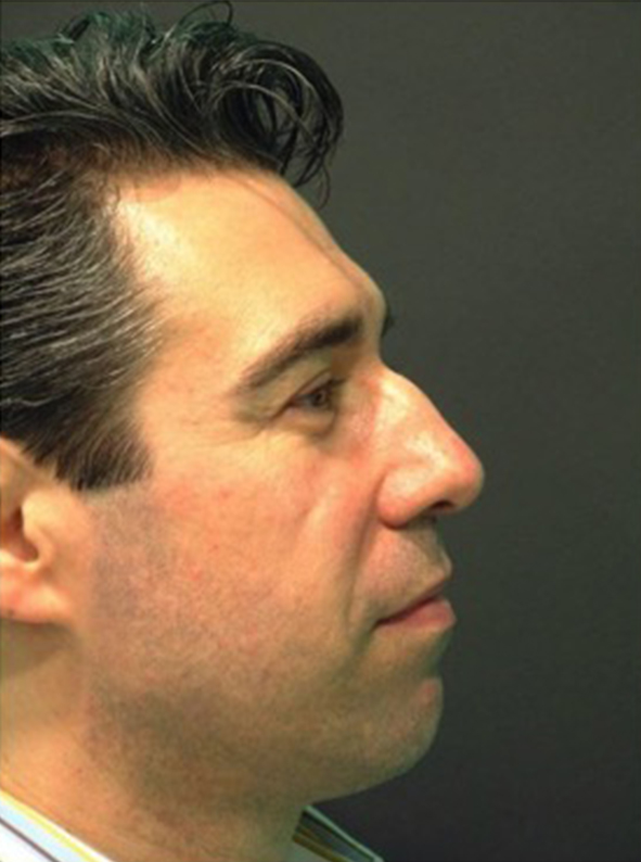Male patient before nonsurgical rhinoplasty