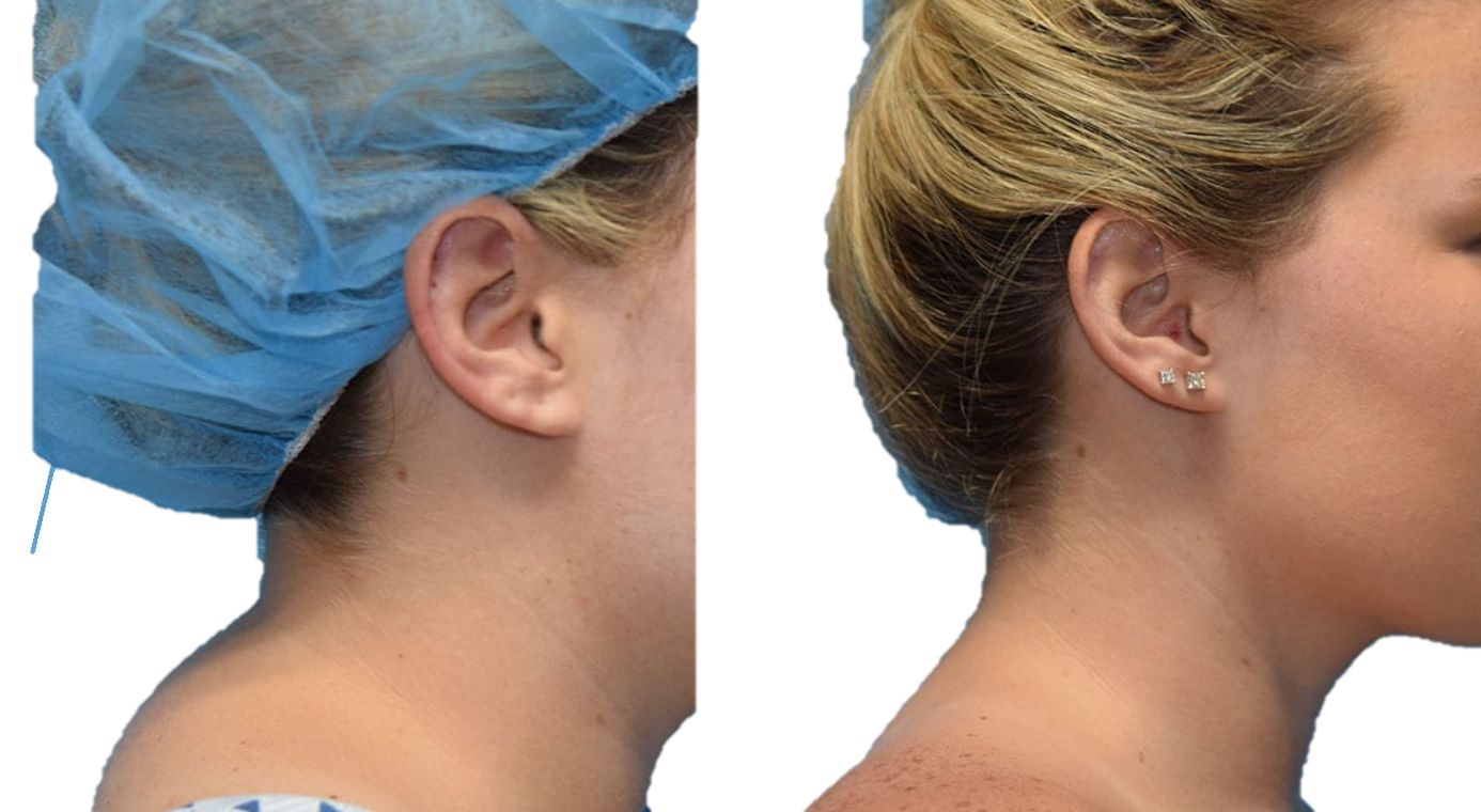 Patient's neck before and after buffalo hump liposuction.