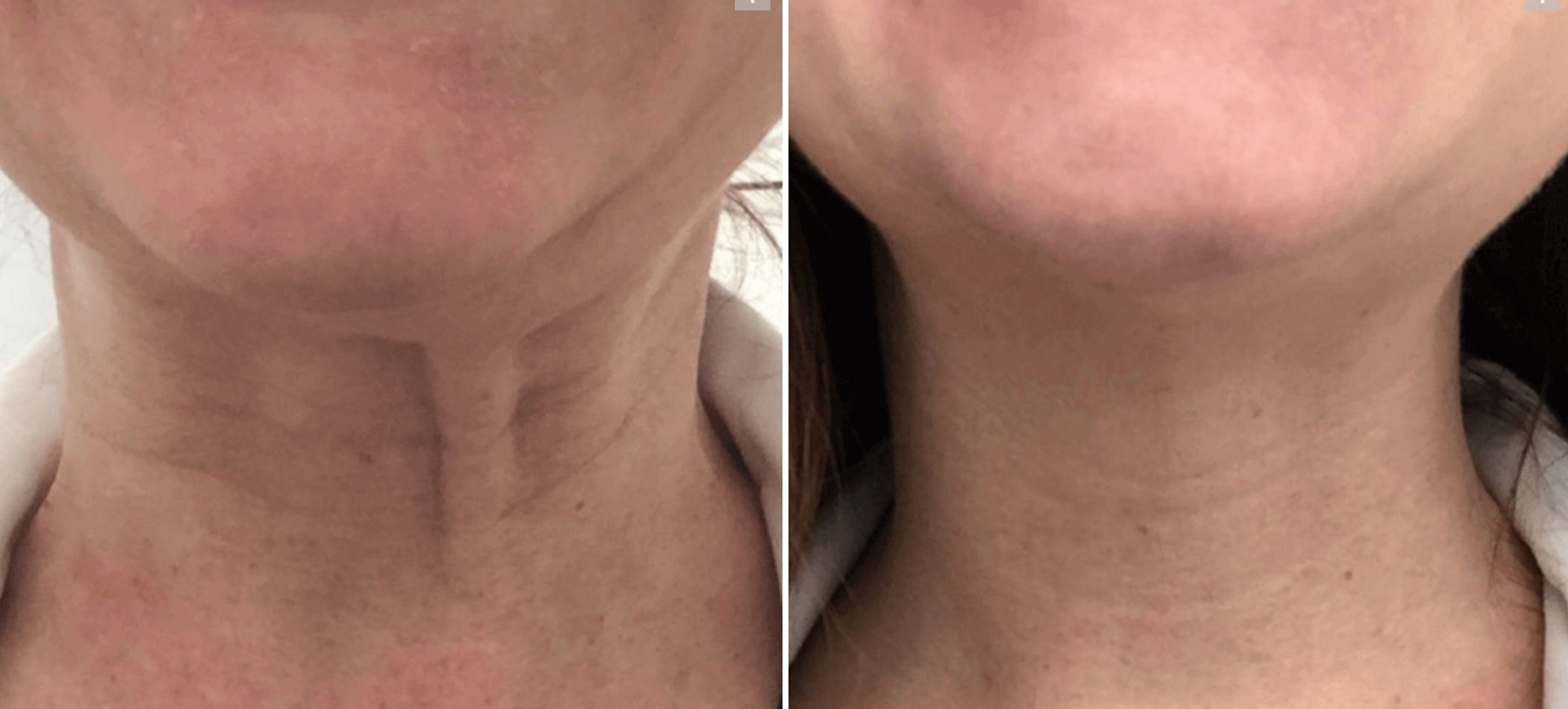 Female patient's neck before and after Botox neck treatment
