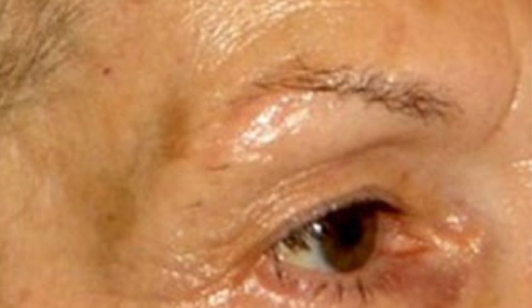Patient after Non-Surgical Neurotox Browlift