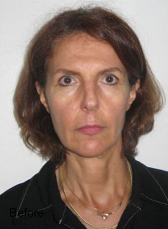 Female patient before Nonsurgical Cheeks Lift and Non-Surgical Fat Face Lift