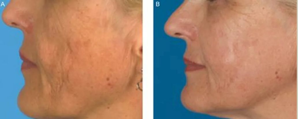 Lower face of female patient before and after Nanofat facelift 