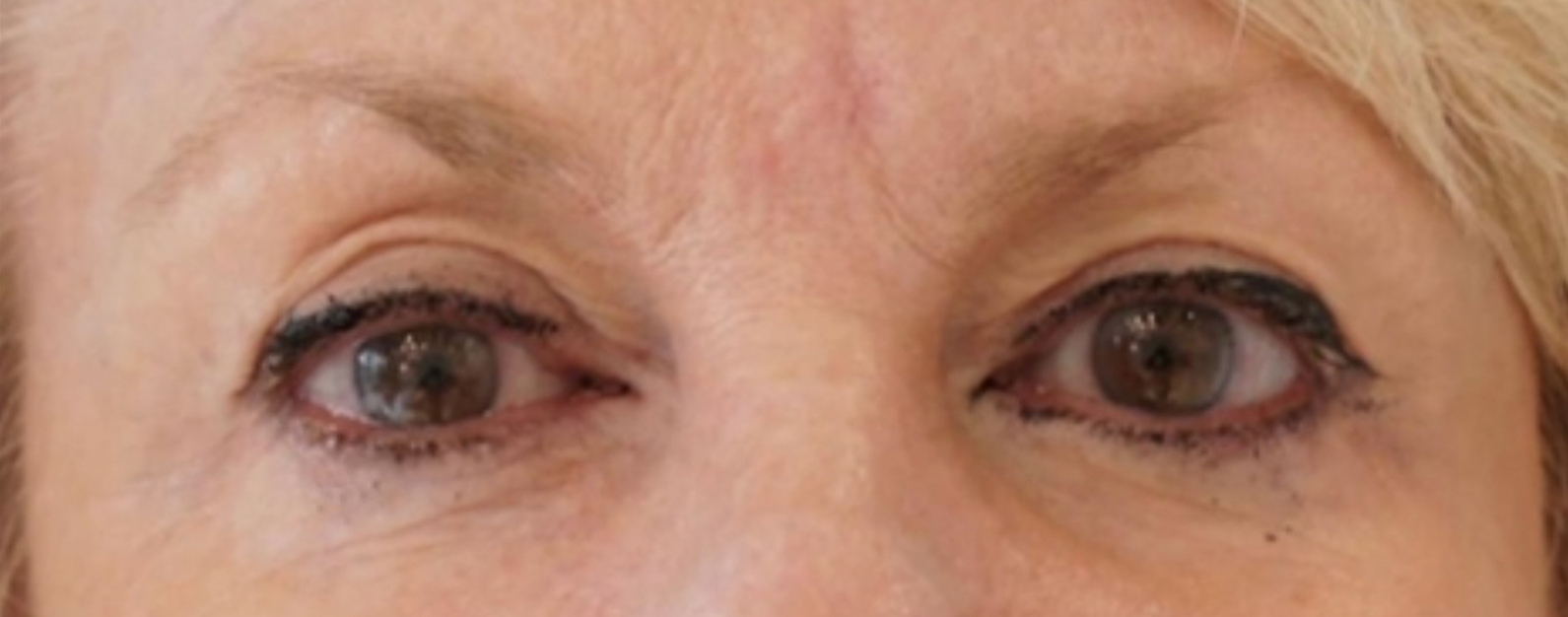 Patient after Nonsurgical Browlift