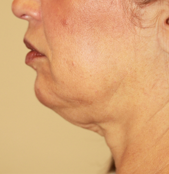Patient before Relift Skin Tightening and Fat Melting Lower Face