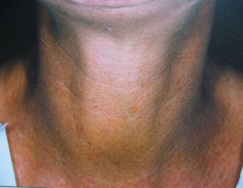 Patient after Neurotox For Turkey Neck and Neck Band Treatment