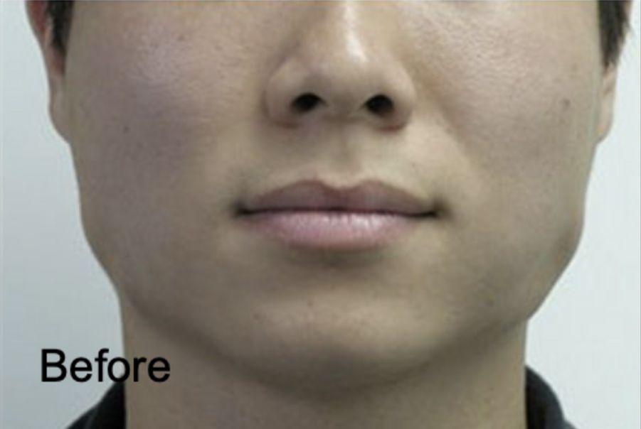 Patient before Neurotox To Contour Your Jawline and Neurotox For Lower Face Slimming