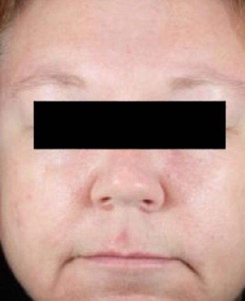 Patient after Neurotox For Large Pores And Acne and Neurotox Nefertiti Lower Facelift
