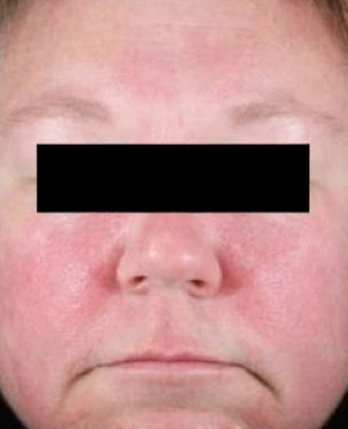 Patient before Neurotox For Large Pores And Acne and Neurotox Nefertiti Lower Facelift