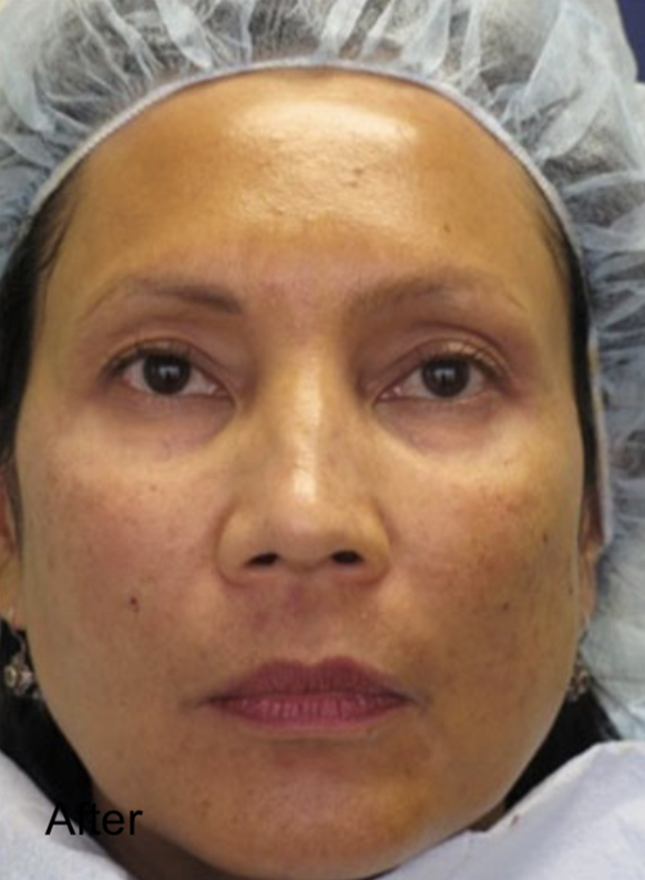 Patient after Non-Surgical Fat Face Lift