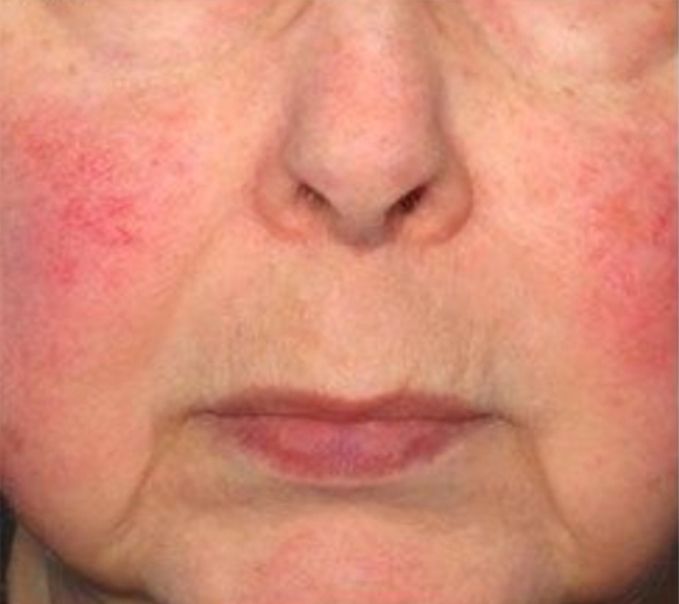Patient before Neurotox For Large Pores And Acne