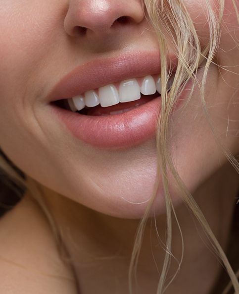Woman's lips after non-surgical lip enhancement
