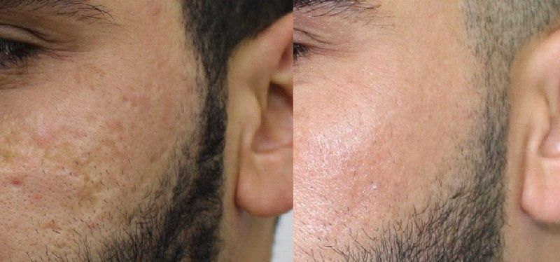 Man's face before and after nanofat injections for acne scar treatment