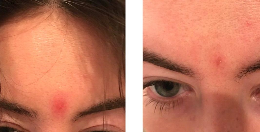 Woman's upper face before and after acne scar treatment with steroid injection 