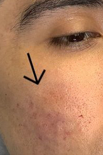 Patient after Acne Scar Treatment