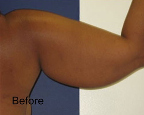 Patient before Arms Lipo