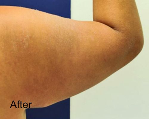 Patient after Arms Lipo
