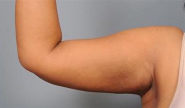Patient after Arms Lipo
