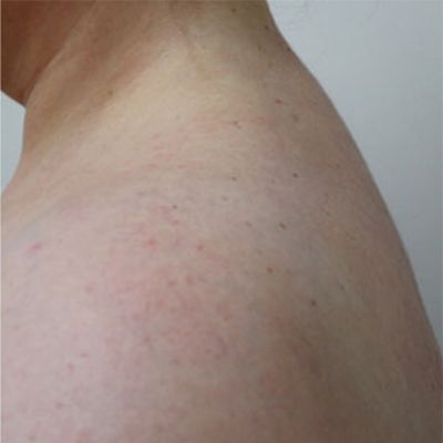Patient after Buffalo Hump Treatment