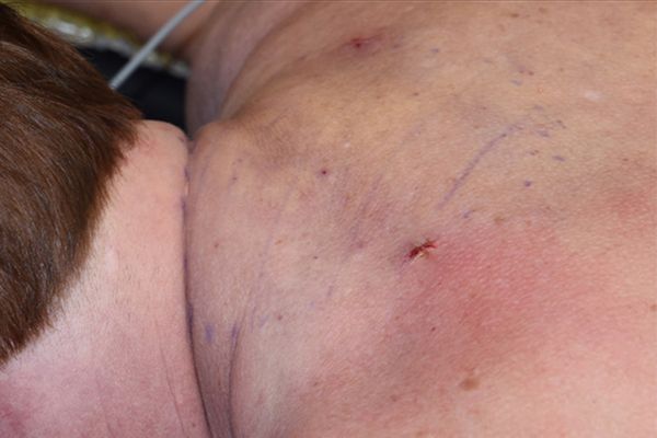 Patient after Buffalo Hump Treatment