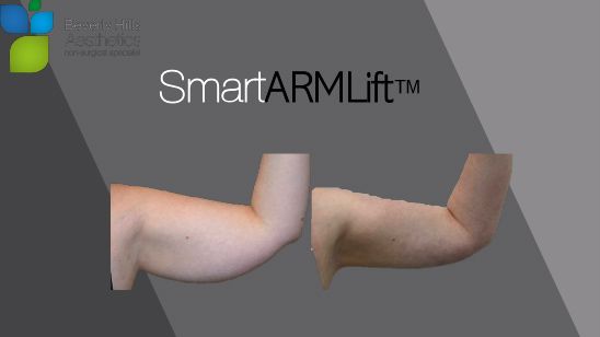 SmartARMLift™ Before and After