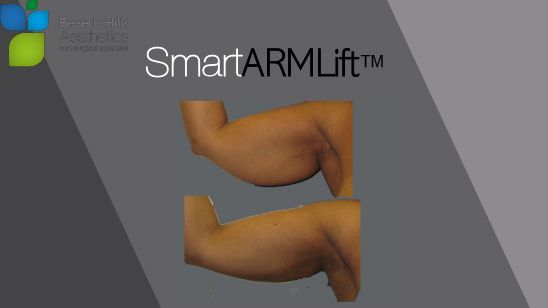Female patient before and after SmartARMLift ™