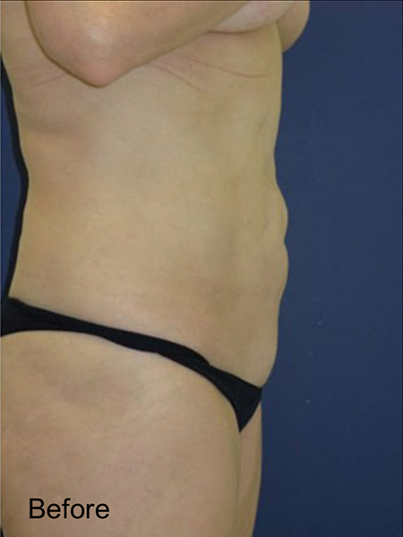 Patient before Botched Lipo