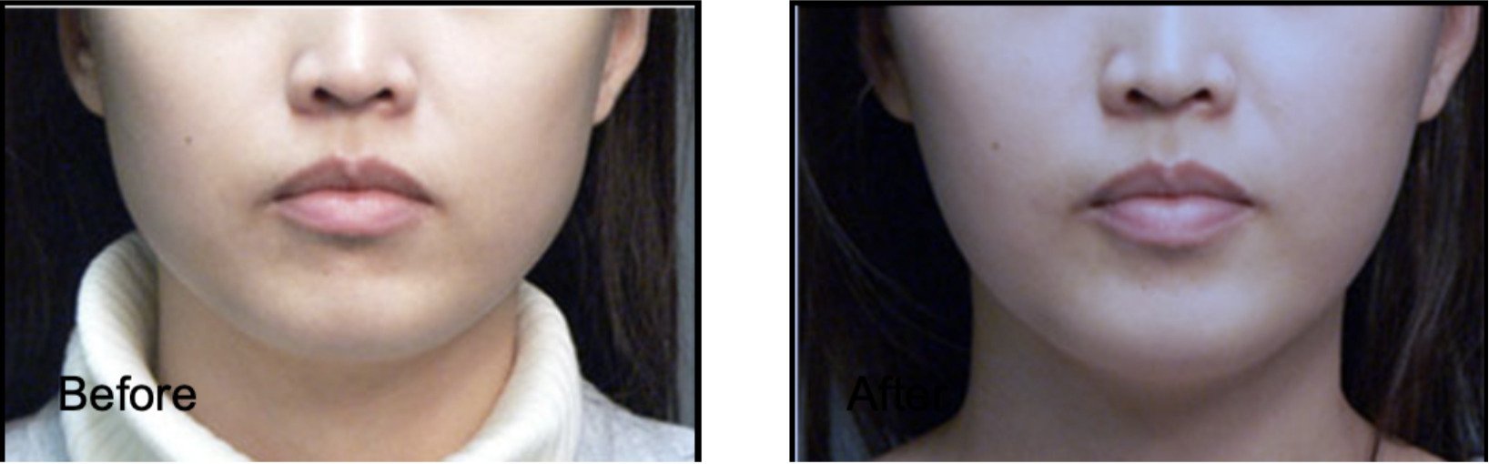 Female patient's lower face before and after Botox face slimming and V face shape contouring