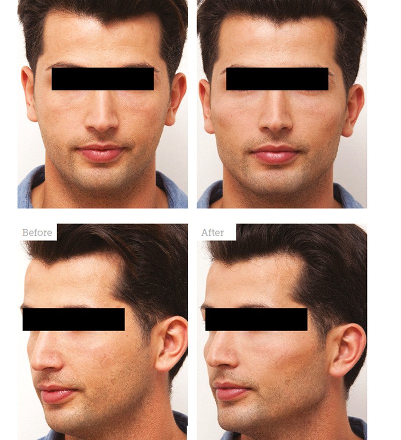 Male patient before and after non-surgical chin enhancement