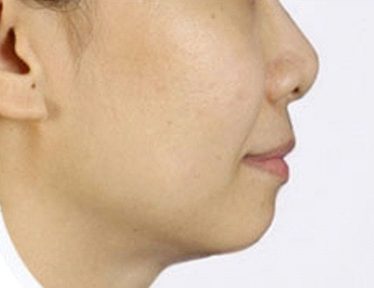 Patient before Nonsurgical Chin Enhancement