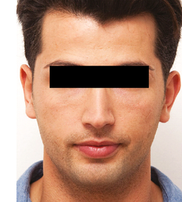 Patient before Nonsurgical Chin Enhancement