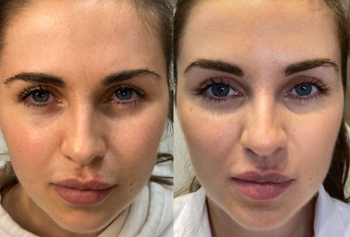 Female patient before and after chemical brow lift with dermal fillers