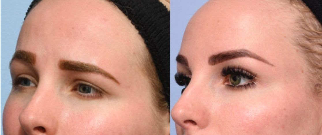 Female patient before and after non-surgical brow lift with fat injections
