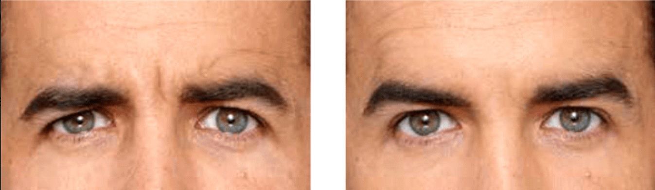 Male patient before and after Botox for frown lines treatment
