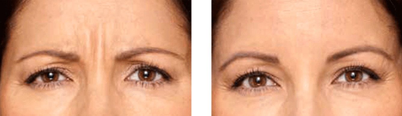 Female patient before and after Botox for frown lines treatment
